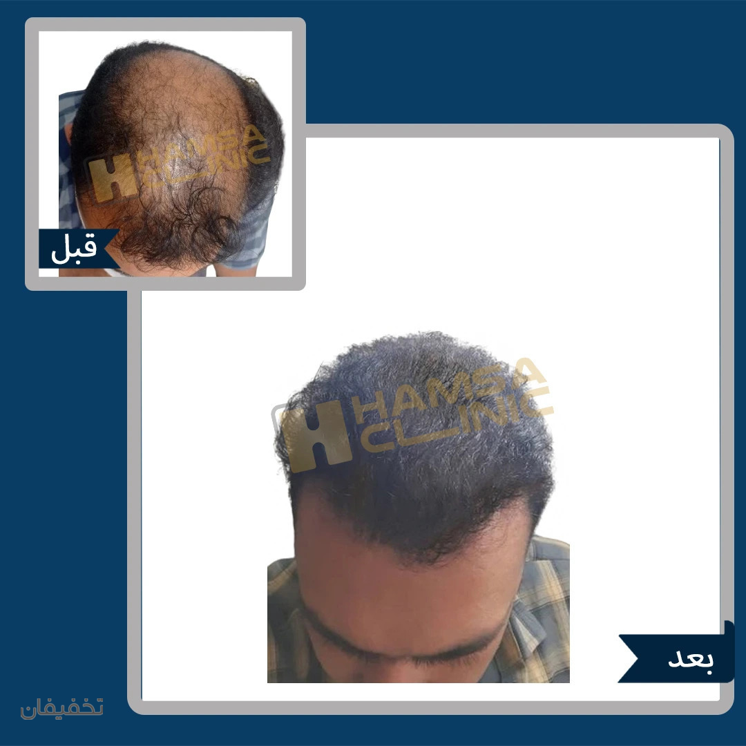 کلینیک کاشت مو و زیبایی همسا